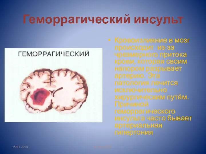 Геморрагический инсульт Кровоизлияние в мозг происходит из-за чрезмерного притока крови,