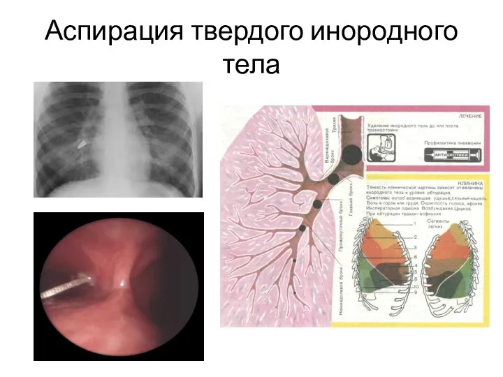 Аспирация твердого инородного тела