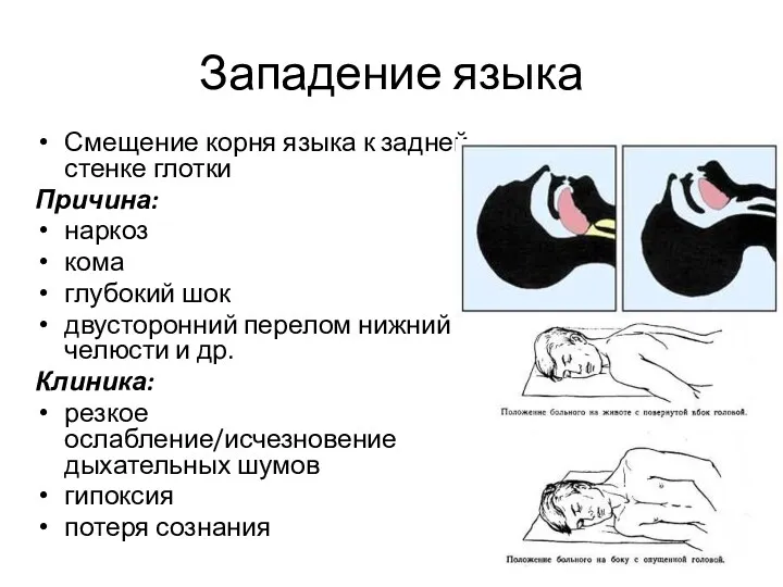 Западение языка Смещение корня языка к задней стенке глотки Причина: