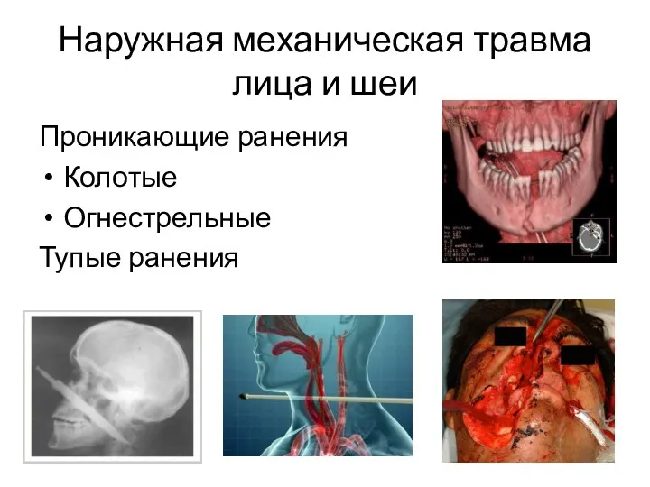 Наружная механическая травма лица и шеи Проникающие ранения Колотые Огнестрельные Тупые ранения