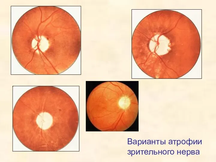 Варианты атрофии зрительного нерва