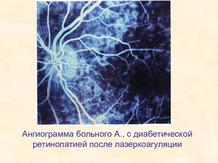 Ангиограмма больного А., с диабетической ретинопатией после лазеркоагуляции