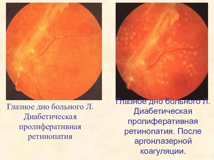 Глазное дно больного Л. Диабетическая пролиферативная ретинопатия Глазное дно больного