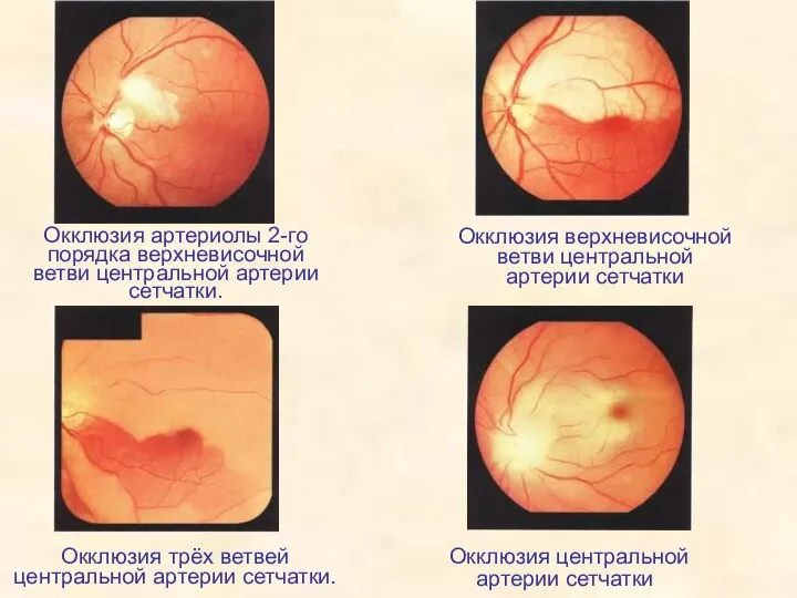 Окклюзия артериолы 2-го порядка верхневисочной ветви центральной артерии сетчатки. Окклюзия