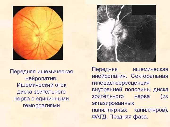 Передняя ишемическая нейропатия. Ишемический отек диска зрительного нерва с единичными