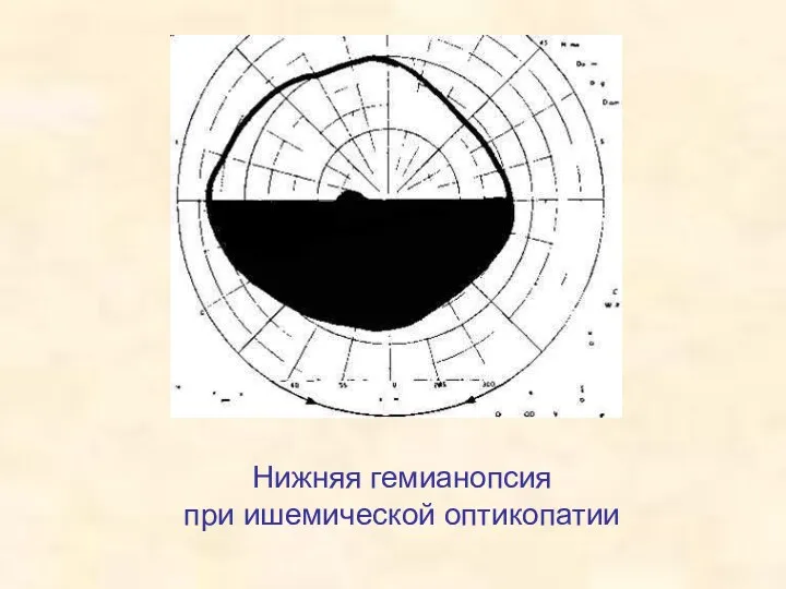 Нижняя гемианопсия при ишемической оптикопатии