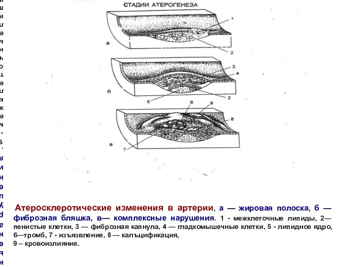 Атеросклеротические изменения в артерии, а — жировая полоска, б —