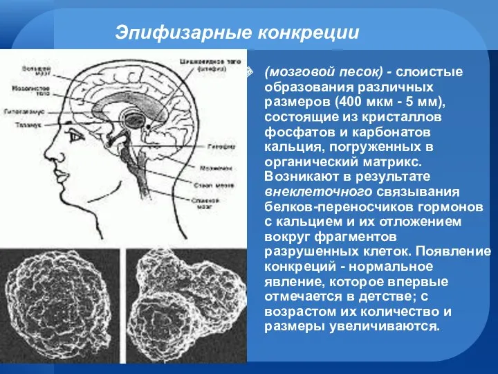 Эпифизарные конкреции (мозговой песок) - слоистые образования различных размеров (400