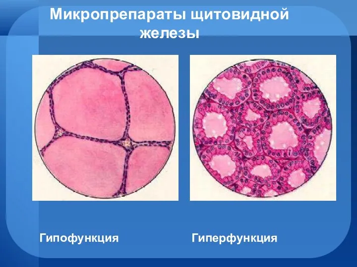 Микропрепараты щитовидной железы Гипофункция Гиперфункция