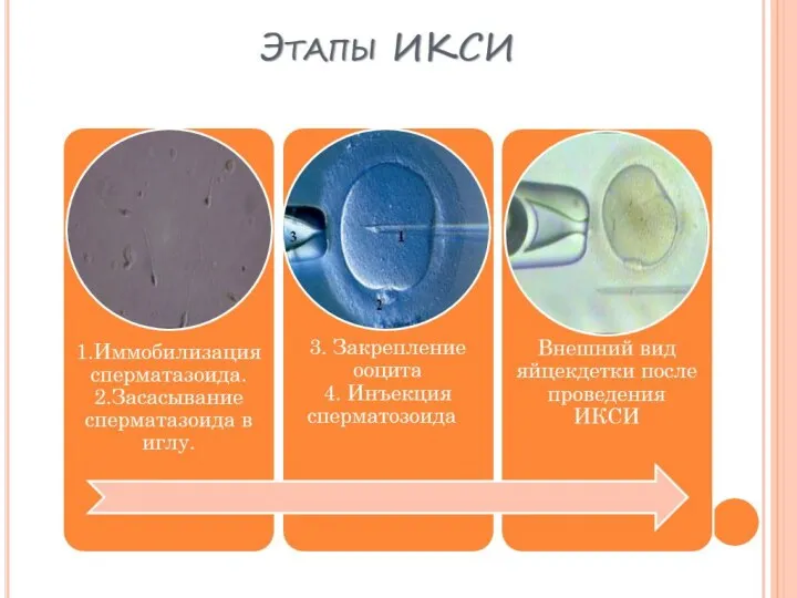 Этапы ИКСИ 1.Иммобилизация сперматазоида. 2.Засасывание сперматазоида в иглу. 3. Закрепление