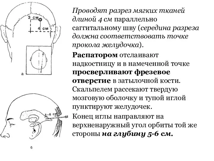 Проводят разрез мягких тканей длиной 4 см параллельно саггитальному шву