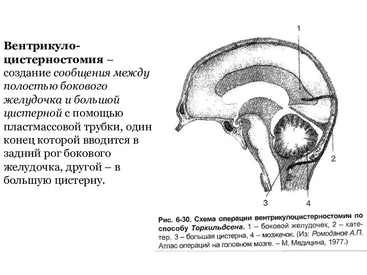 Вентрикуло-цистерностомия – создание сообщения между полостью бокового желудочка и большой