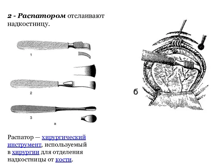 Распатор — хирургический инструмент, используемый в хирургии для отделения надкостницы