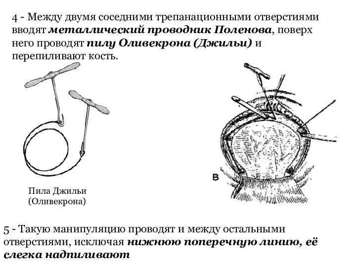 4 - Между двумя соседними трепанационными отверстиями вводят металлический проводник