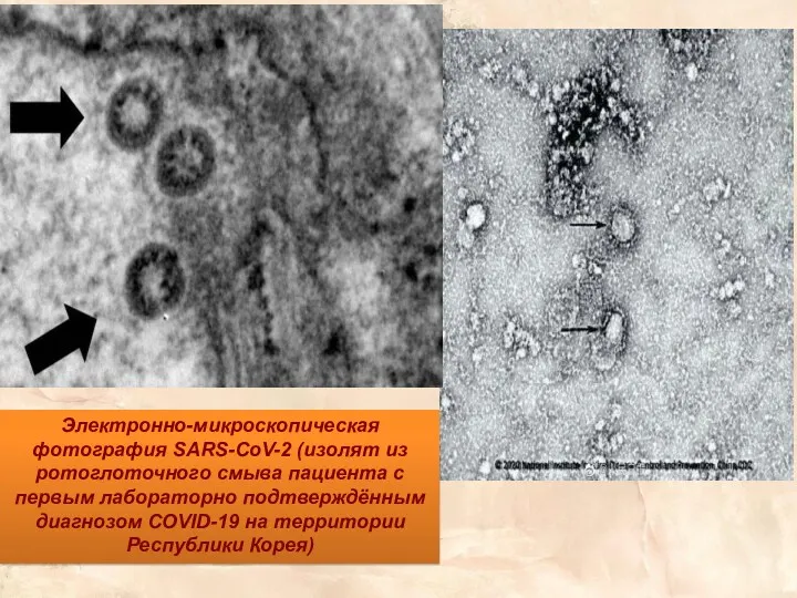 Электронно-микроскопическая фотография SARS-CoV-2 (изолят из ротоглоточного смыва пациента с первым