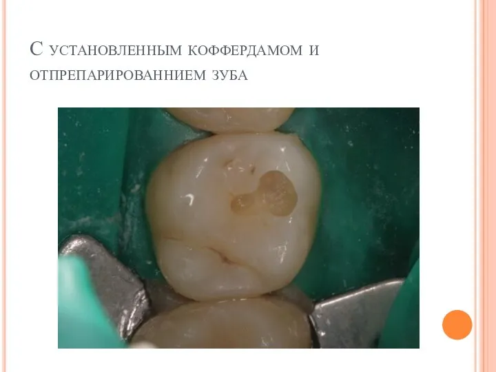 С установленным коффердамом и отпрепарированнием зуба