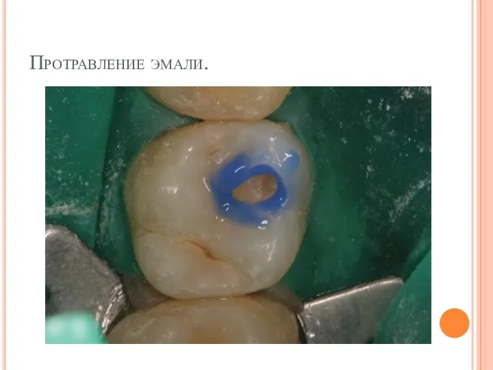 Протравление эмали.