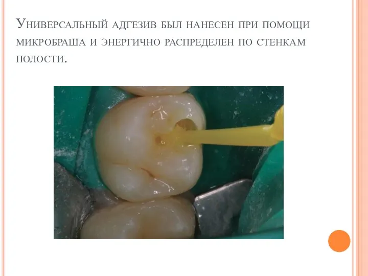 Универсальный адгезив был нанесен при помощи микробраша и энергично распределен по стенкам полости.