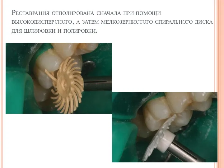 Реставрация отполирована сначала при помощи высокодисперсного, а затем мелкозернистого спирального диска для шлифовки и полировки.