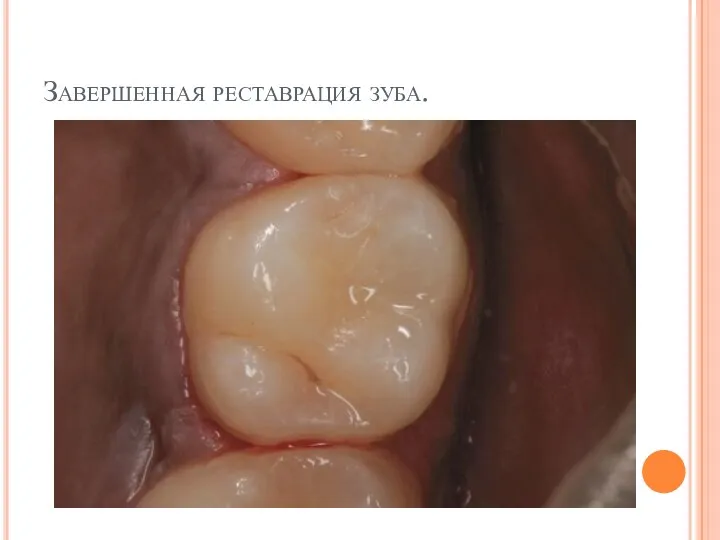 Завершенная реставрация зуба.