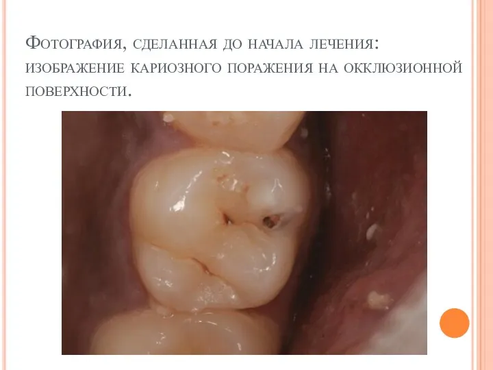 Фотография, сделанная до начала лечения: изображение кариозного поражения на окклюзионной поверхности.