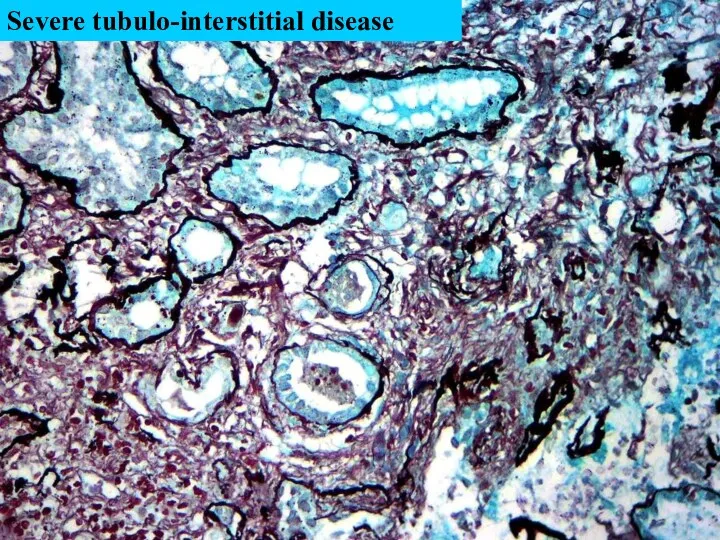 Severe tubulo-interstitial disease