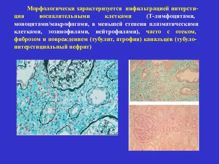 Морфологически характеризуется инфильтрацией интерсти-ция воспалительными клетками (Т-лимфоцитами, моноцитами/макрофагами, в меньшей