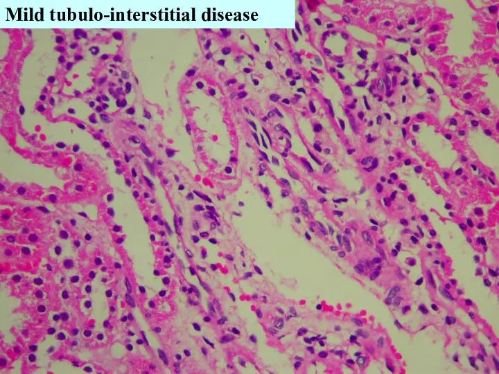 Mild tubulo-interstitial disease