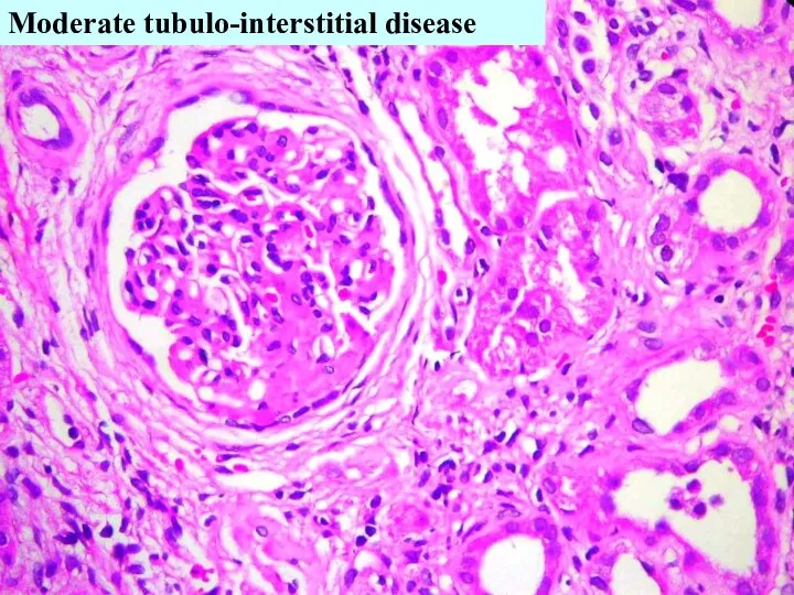 Moderate tubulo-interstitial disease