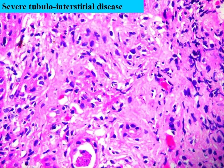 Severe tubulo-interstitial disease