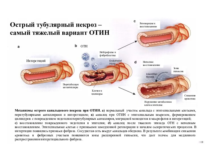 Механизмы острого канальцевого некроза при ОТИН. а) нормальный участок канальца