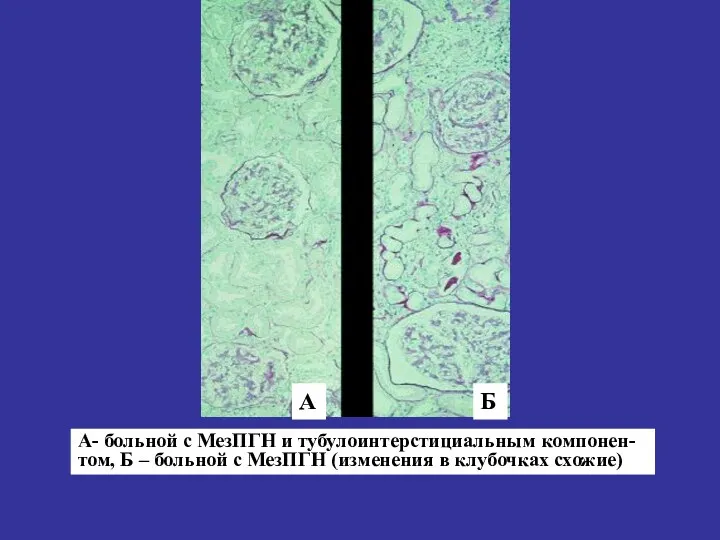 А- больной с МезПГН и тубулоинтерстициальным компонен-том, Б – больной