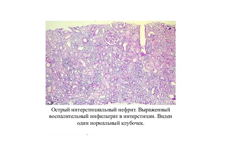Острый интерстициальный нефрит. Выраженный воспалительный инфильтрат в интерстиции. Виден один нормальный клубочек.