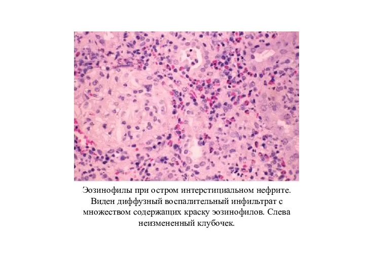 Эозинофилы при остром интерстициальном нефрите. Виден диффузный воспалительный инфильтрат с