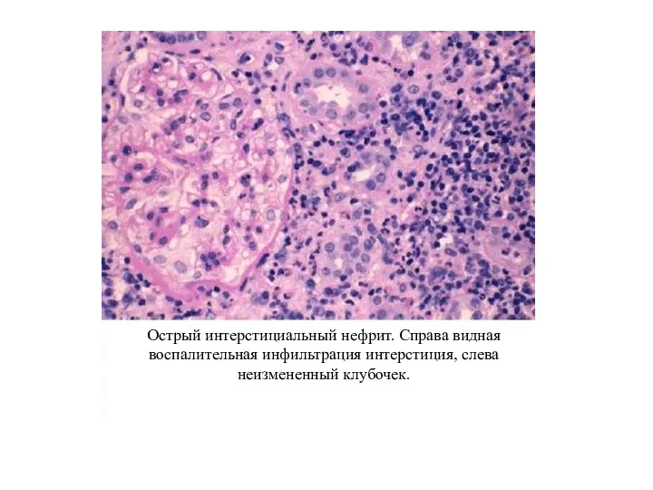 Острый интерстициальный нефрит. Справа видная воспалительная инфильтрация интерстиция, слева неизмененный клубочек.