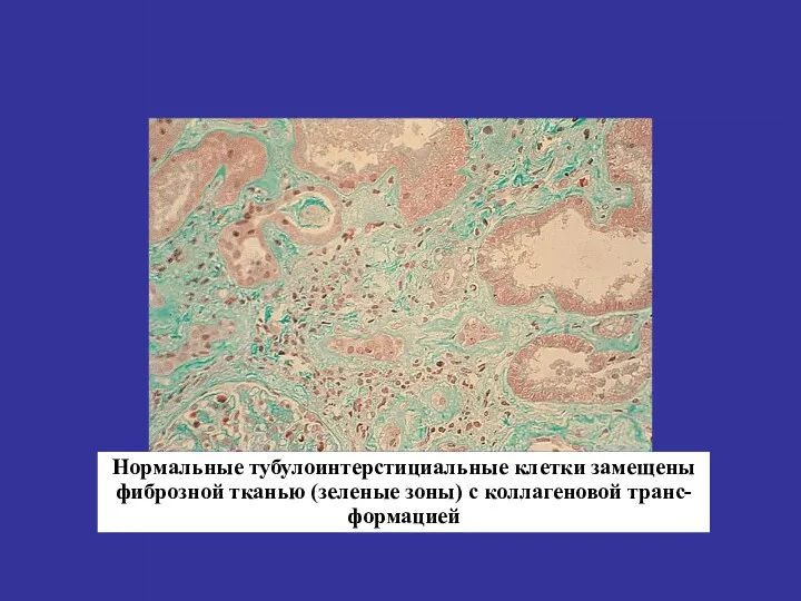 Нормальные тубулоинтерстициальные клетки замещены фиброзной тканью (зеленые зоны) с коллагеновой транс-формацией