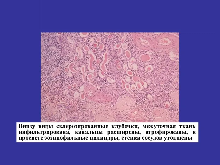 Внизу виды склерозированные клубочки, межуточная ткань инфильтрирована, канальцы расширены, атрофированы,