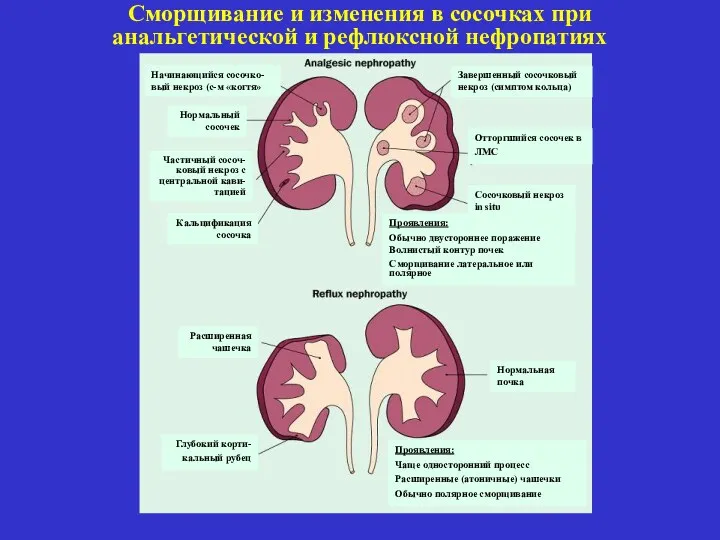 Сморщивание и изменения в сосочках при анальгетической и рефлюксной нефропатиях