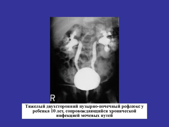 Тяжелый двухсторонний пузырно-почечный рефлюкс у ребенка 10 лет, сопровождающийся хронической инфекцией мочевых путей