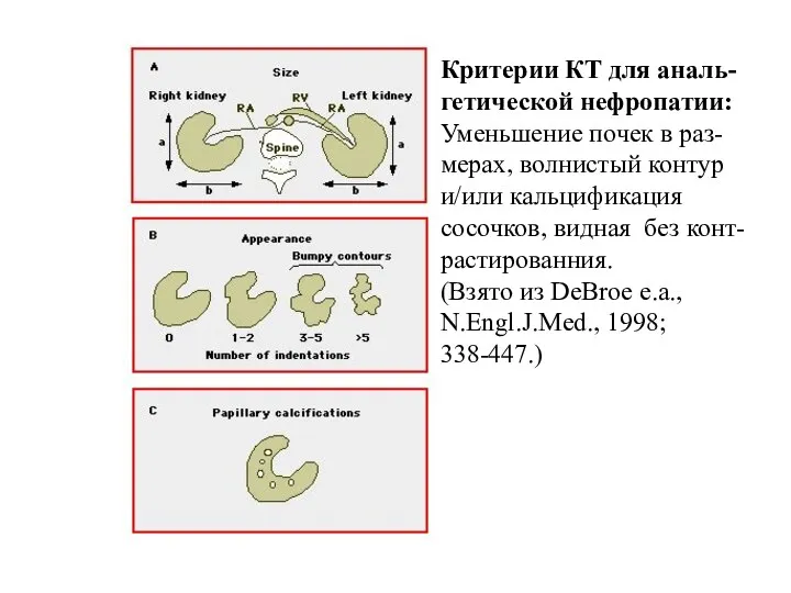 Критерии КТ для аналь-гетической нефропатии: Уменьшение почек в раз-мерах, волнистый