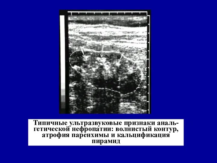 Типичные ультразвуковые признаки аналь-гетической нефропатии: волнистый контур, атрофия паренхимы и кальцификация пирамид