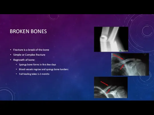 BROKEN BONES Fracture is a break of the bone Simple