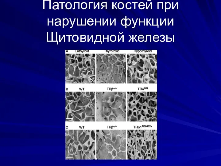 Патология костей при нарушении функции Щитовидной железы