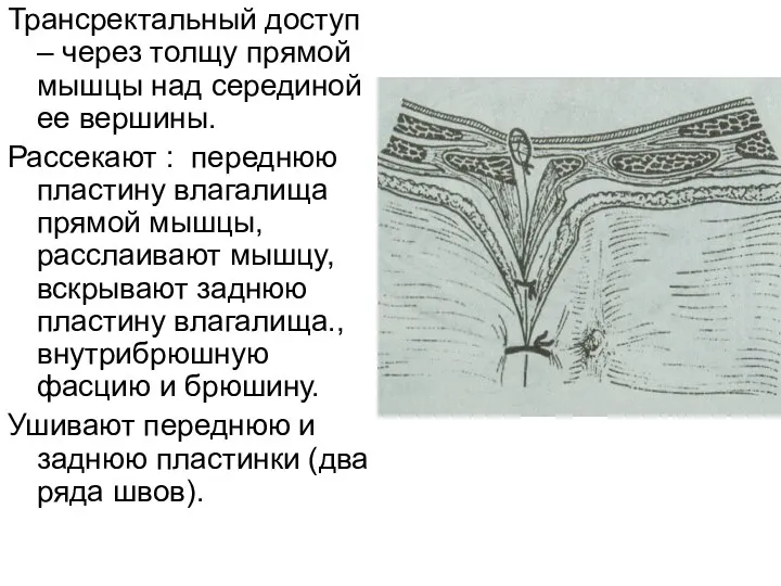 Трансректальный доступ – через толщу прямой мышцы над серединой ее