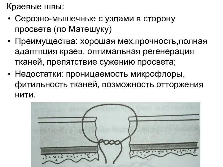 Краевые швы: Серозно-мышечные с узлами в сторону просвета (по Матешуку)