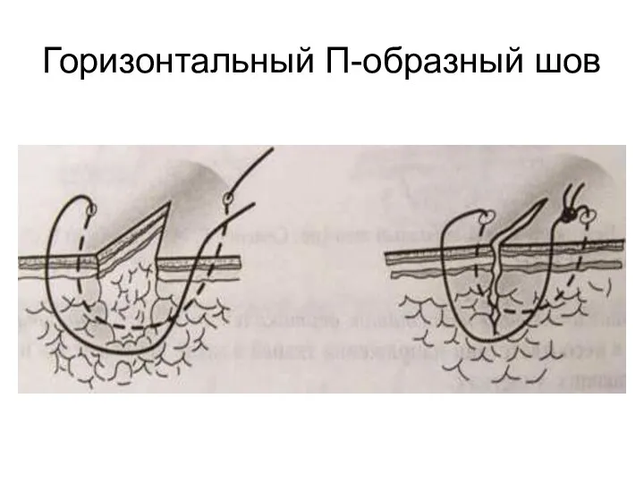 Горизонтальный П-образный шов