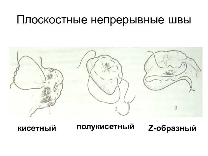 Плоскостные непрерывные швы кисетный полукисетный Z-образный