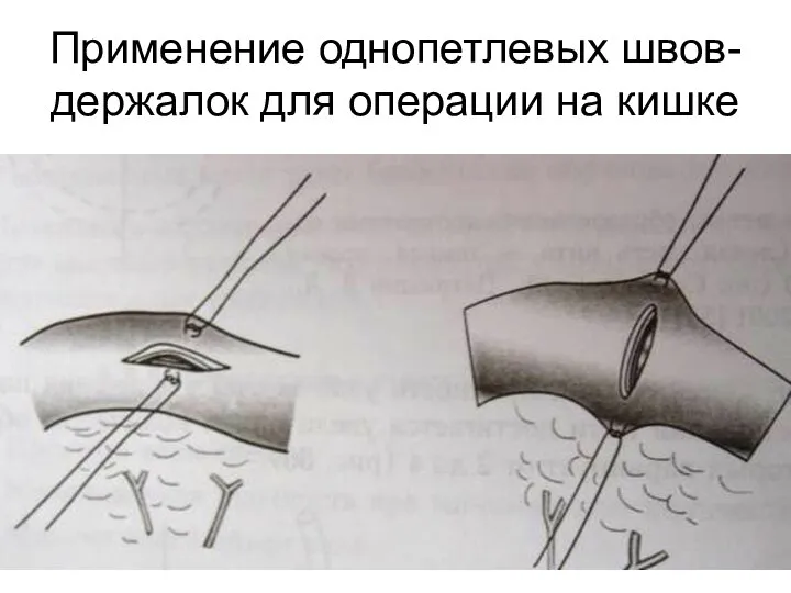 Применение однопетлевых швов-держалок для операции на кишке