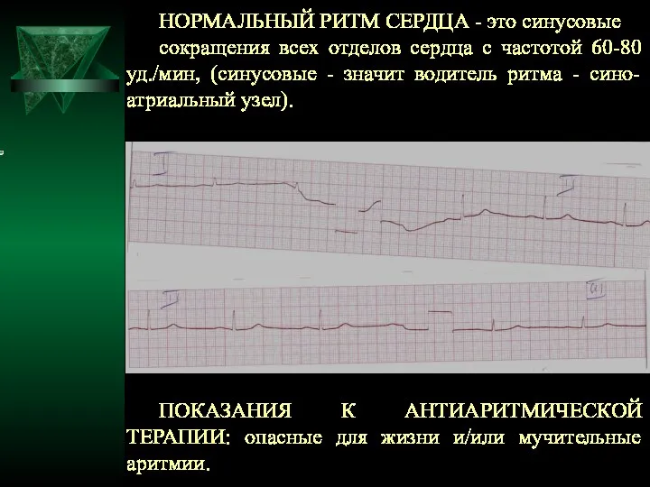 НОРМАЛЬНЫЙ РИТМ СЕРДЦА - это синусовые сокращения всех отделов сердца