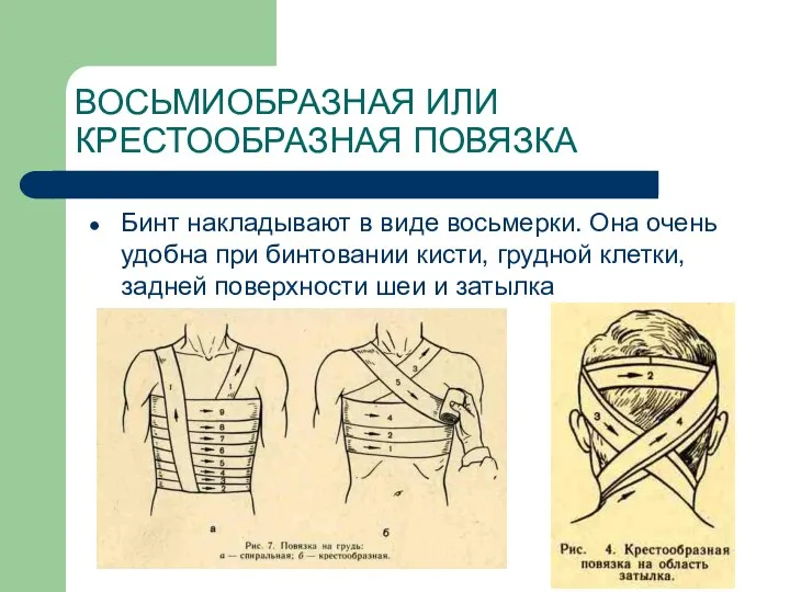 ВОСЬМИОБРАЗНАЯ ИЛИ КРЕСТООБРАЗНАЯ ПОВЯЗКА Бинт накладывают в виде восьмерки. Она